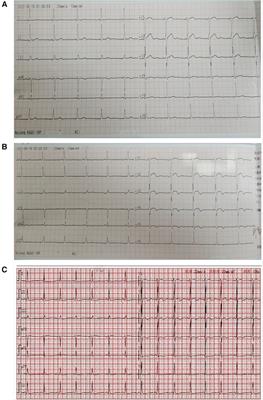 Case Report: Kounis syndrome due to cryptopteran bite